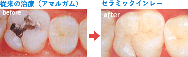 セラミックインレー