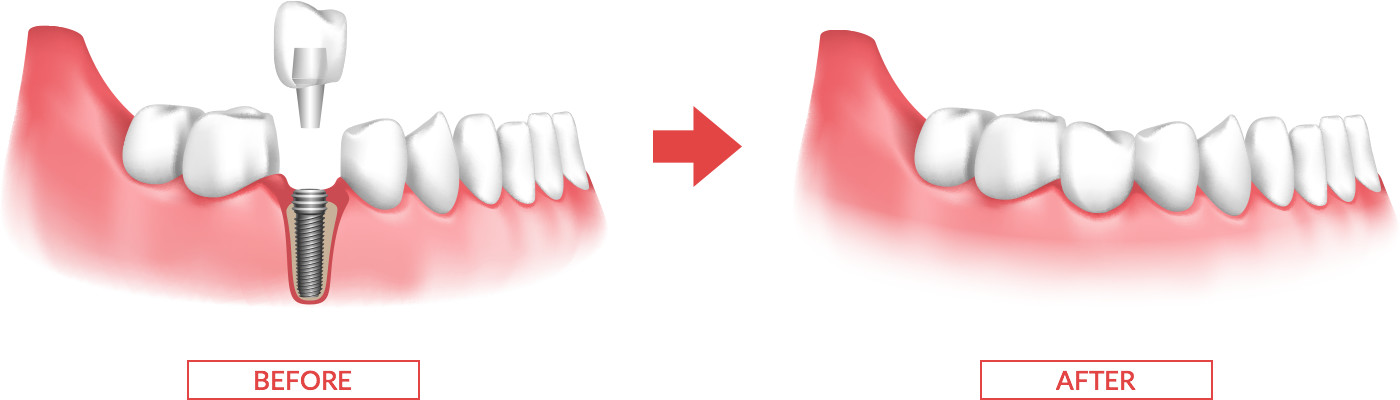 インプラント 従来の治療方法との違い