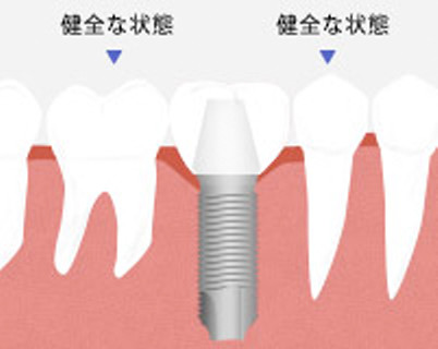 CASE1 健全な歯を削りたくない（ブリッジ治療⇒インプラント治療）