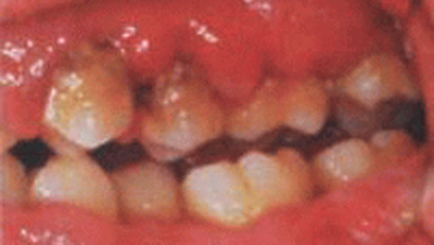 重度歯周炎(歯槽膿漏)