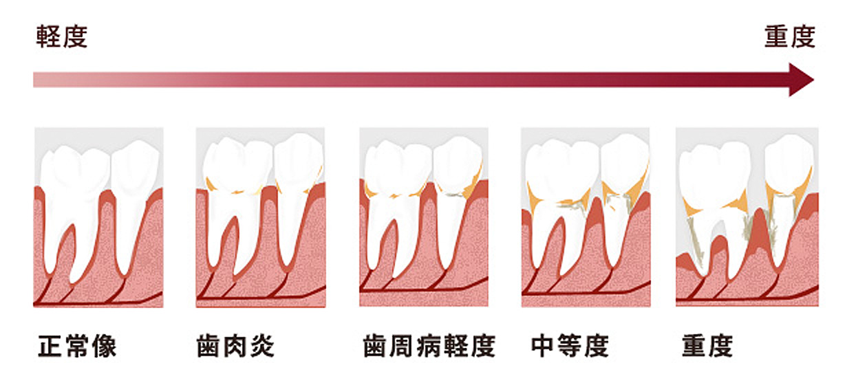 歯周病は、国民病というけど、本当は、どんな病気でしょうか？