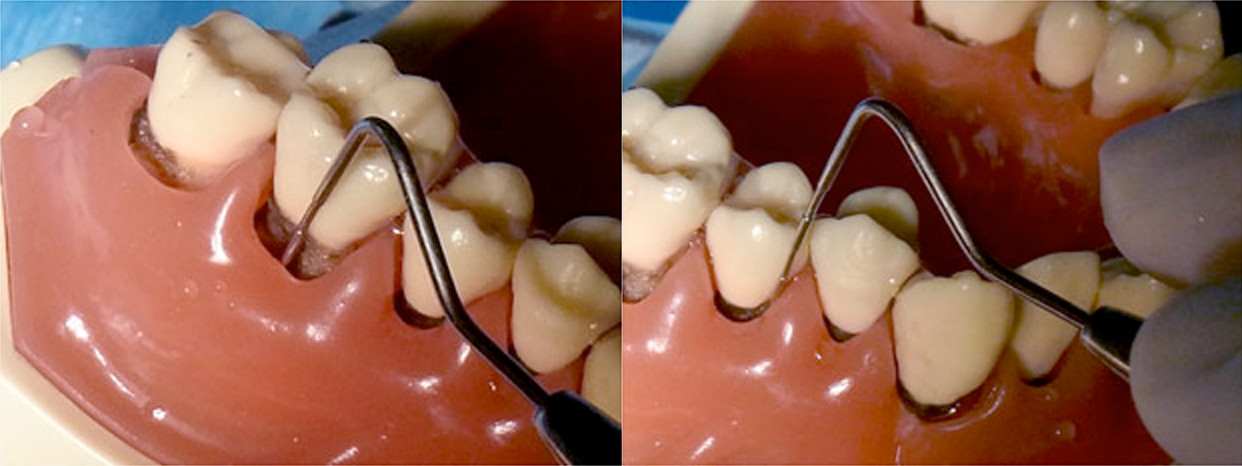 歯周ポケットにプローペを使用した検査（写真は模型を使用）