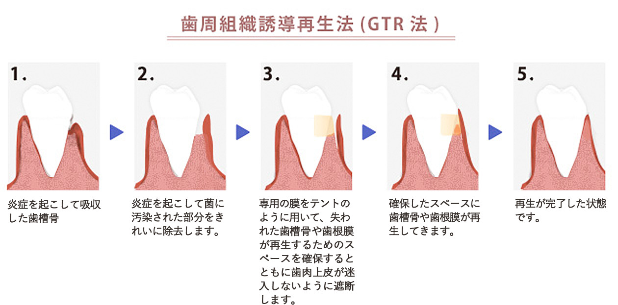 歯周組織誘導再生法(GTR法)